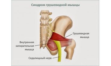 Боль в пояснице и ноге: синдром грушевидной мышцы