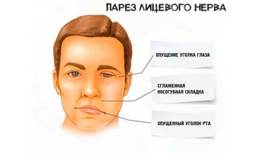 Парез лицевого нерва: как остеопатия поможет с неврологическим расстройством