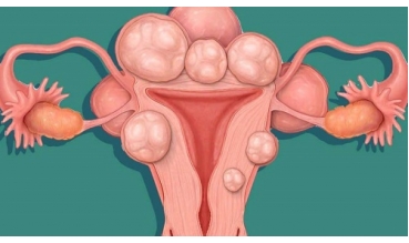 Остеопатия при кисте яичников и миоме матки