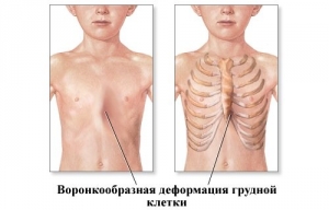 Воронкообразная (впалая) грудная клетка у ребенка