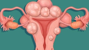 Остеопатия при кисте яичников и миоме матки